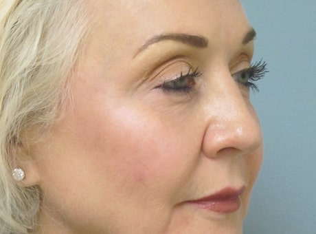 mature female patient after lip filler treatment