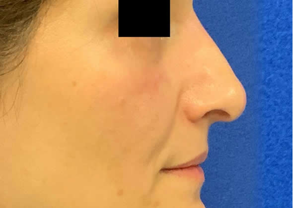 Female patient after non-surgical rhinoplasty