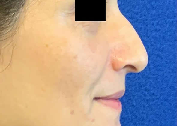 Female patient before non-surgical rhinoplasty