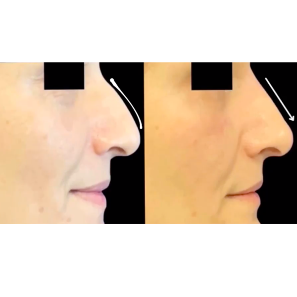 Photo of the patient before and after non-surgical nose correction