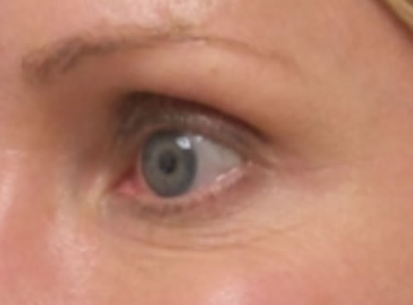 female patient after botox for crow's feet treatment