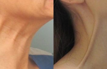 neck botox before and after