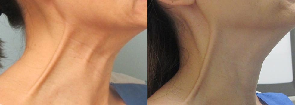 neck botox before and after