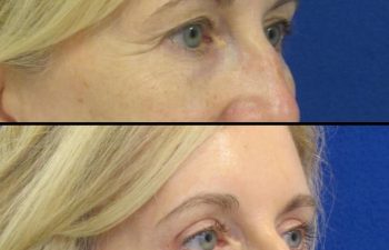 Female Patient Before & After Blepharoplasty