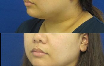 Female Patient Before & After Neck Liposuction