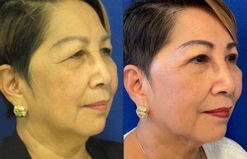 Female Patient Before & After Blepharoplasty
