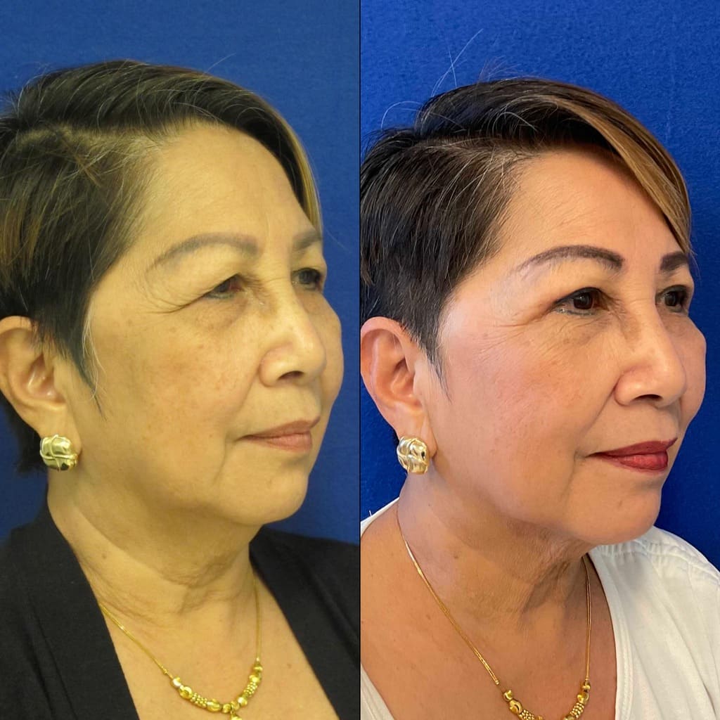 Female Patient Before & After Blepharoplasty