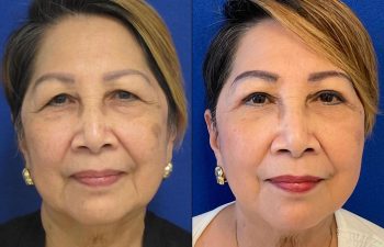 Female Patient Before & After Blepharoplasty