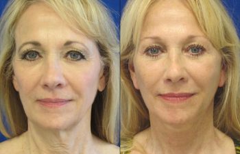 Female Patient Before & After Blepharoplasty