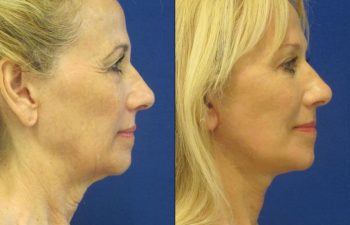 Female Patient Before & After Blepharoplasty