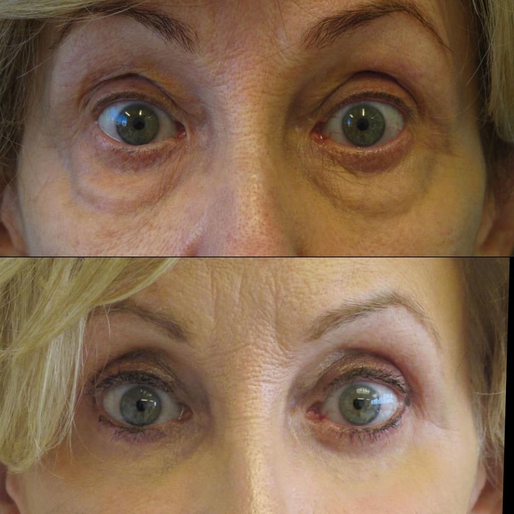 Female Patient Before & After Blepharoplasty