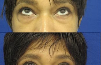 Female Patient Before & After Blepharoplasty