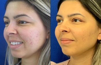 Female Patient Before & After Blepharoplasty