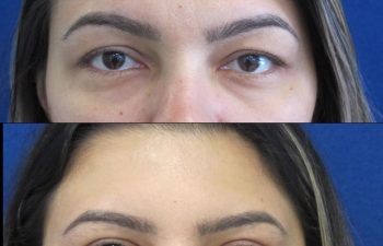 Female Patient Before & After Blepharoplasty