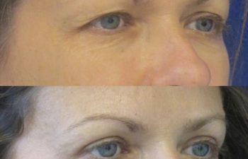 Female Patient Before & After Blepharoplasty