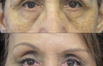 Female Patient Before & After Blepharoplasty