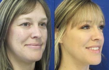 Female Patient Before & After Blepharoplasty