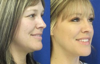 Female Patient Before & After Blepharoplasty