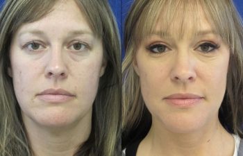 Female Patient Before & After Blepharoplasty