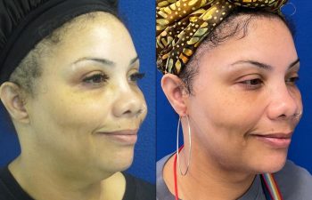 Female Patient Before & After Neck Liposuction