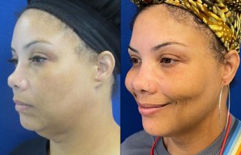 Female Patient Before & After Neck Liposuction