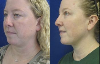 Female Patient Before & After Blepharoplasty