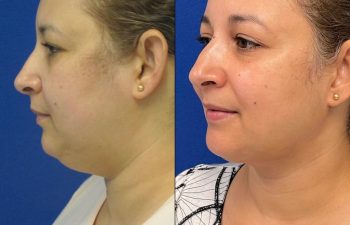 Female Patient Before & After Neck Liposuction