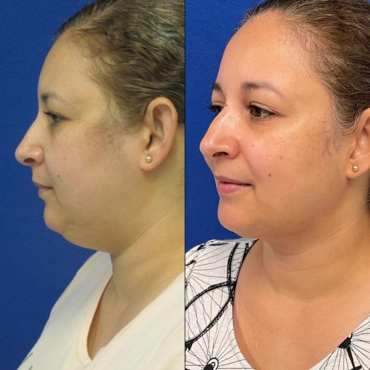 Female Patient Before & After Neck Liposuction