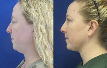 Female Patient Before & After Blepharoplasty