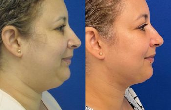 Female Patient Before & After Neck Liposuction