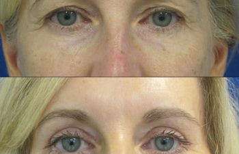 Female Patient Before & After Blepharoplasty