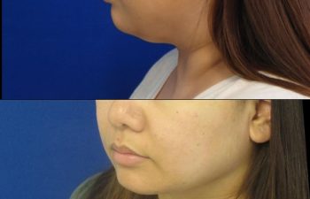 Female Patient Before & After Neck Liposuction
