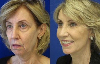 Female Patient Before & After Blepharoplasty