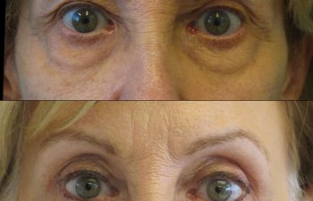 Female Patient Before & After Blepharoplasty