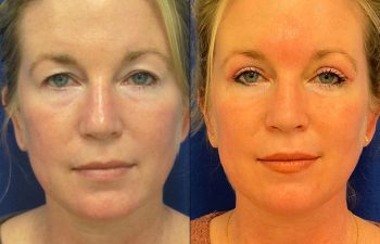 Female Patient Before & After Blepharoplasty