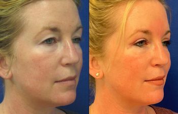 Female Patient Before & After Blepharoplasty