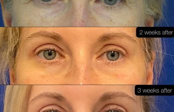 Female Patient Before & After Blepharoplasty