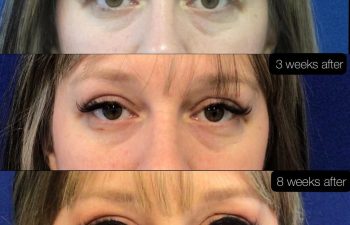 Female Patient Before & After Blepharoplasty