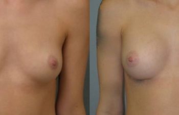 Female Patient Before & After Breast Augmentation