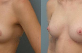 Female Patient Before & After Breast Augmentation