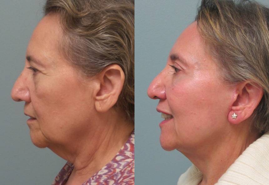 Female Patient Before & After FaceLift