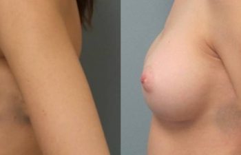 Female Patient Before & After Breast Augmentation