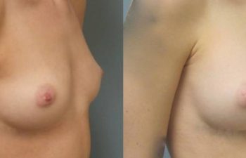 Female Patient Before & After Breast Augmentation