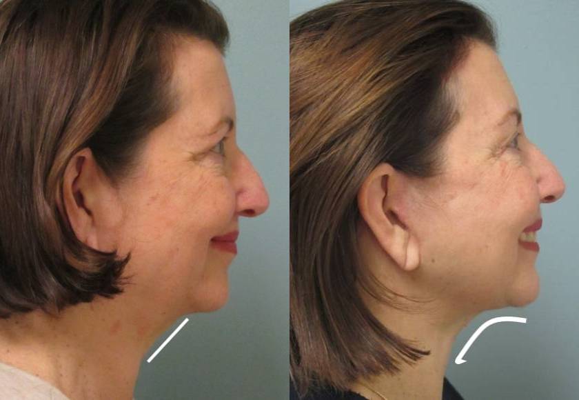 Female Patient Before & After FaceLift