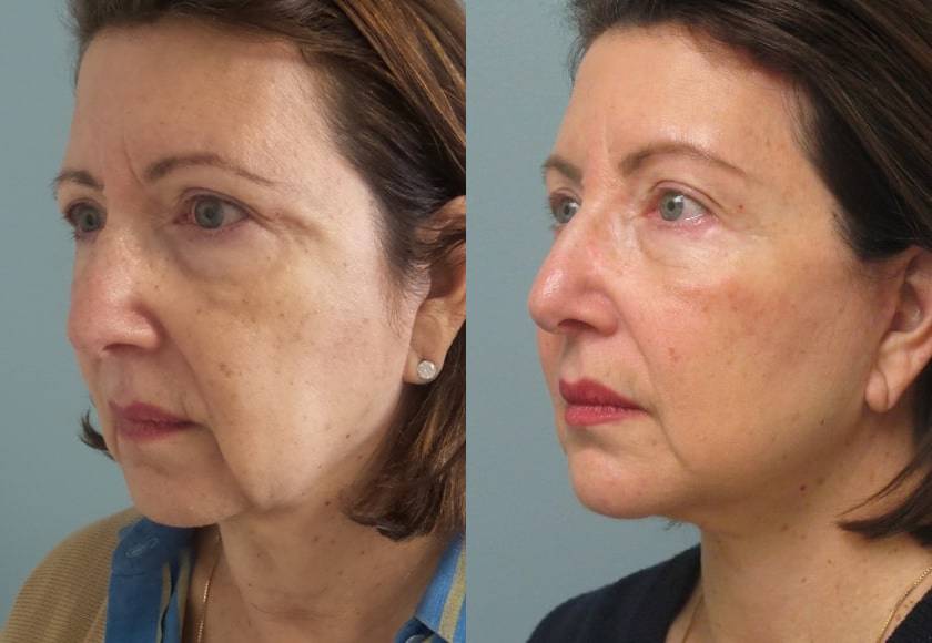 Female Patient Before & After FaceLift