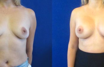 Female Patient Before & After Breast Augmentation