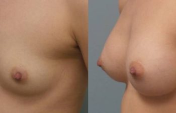 Female Patient Before & After Breast Augmentation