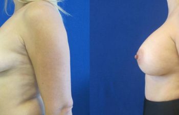 Female Patient Before & After Breast Augmentation