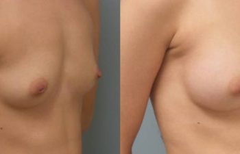 Female Patient Before & After Breast Augmentation