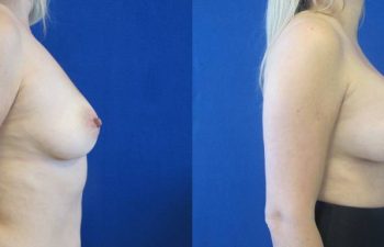 Female Patient Before & After Breast Augmentation